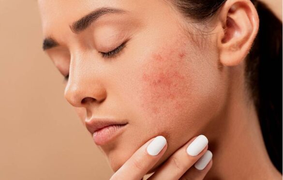 Acne Scars