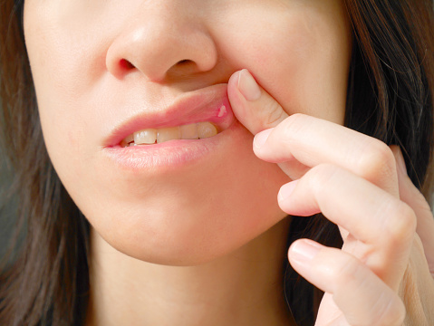 Seven ways to Prevent Canker Sores in 24 hours with home Remedies