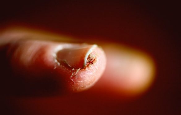  How to Cure Finger Nail Fungus Fastly with these Remedies