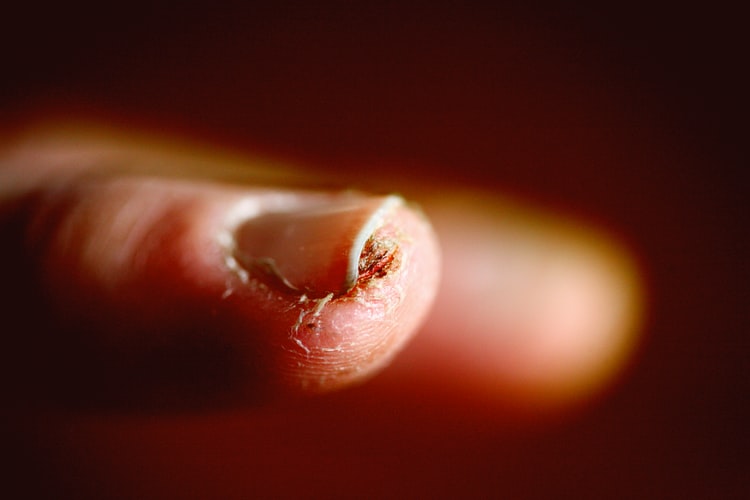 fingernail fungus