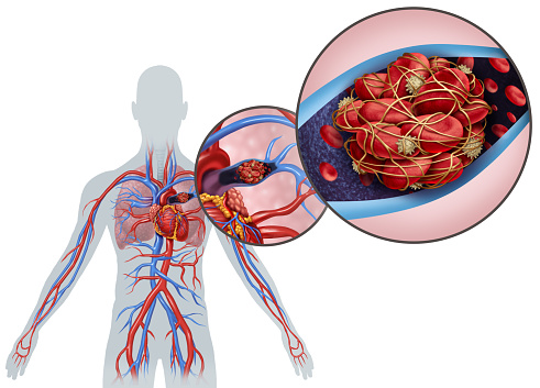 When Should You Worry About Blood Clots and What Are the Best Treatments