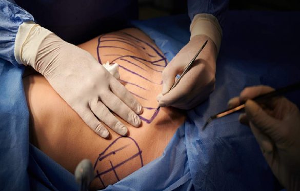  Tummy Tuck Costs Across Different US Cities and States