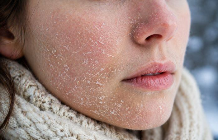 close-up of dry flaky skin caused by cold winter weather
